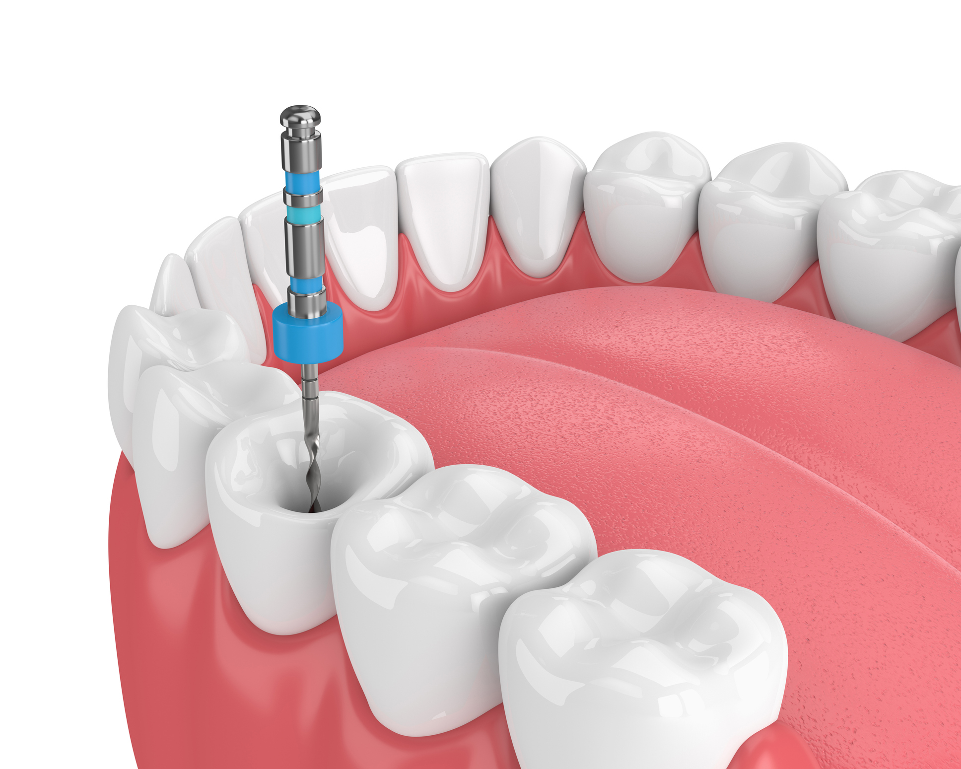 Endodoncia en Madrid