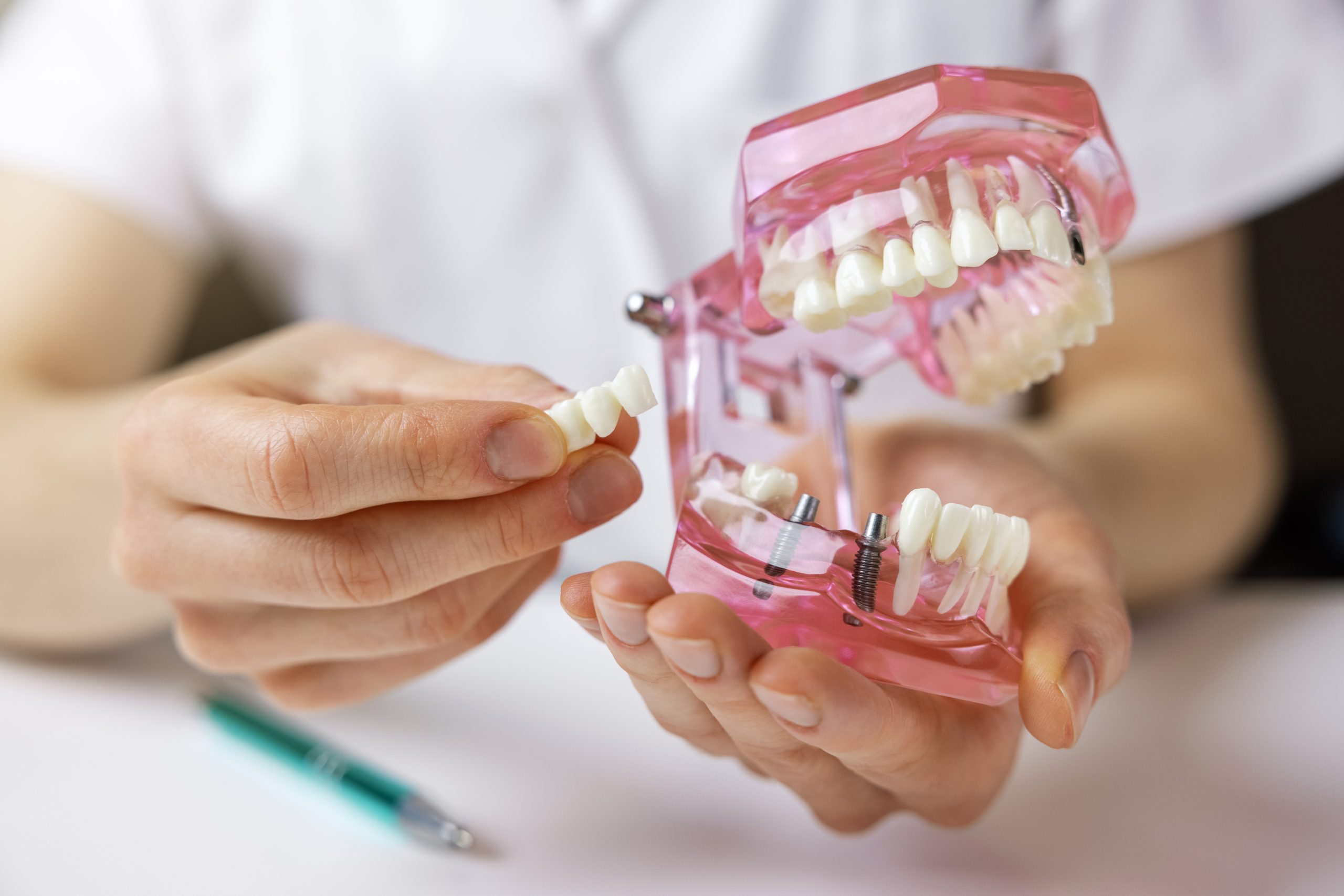 Implantes dentales en Valdebebas
