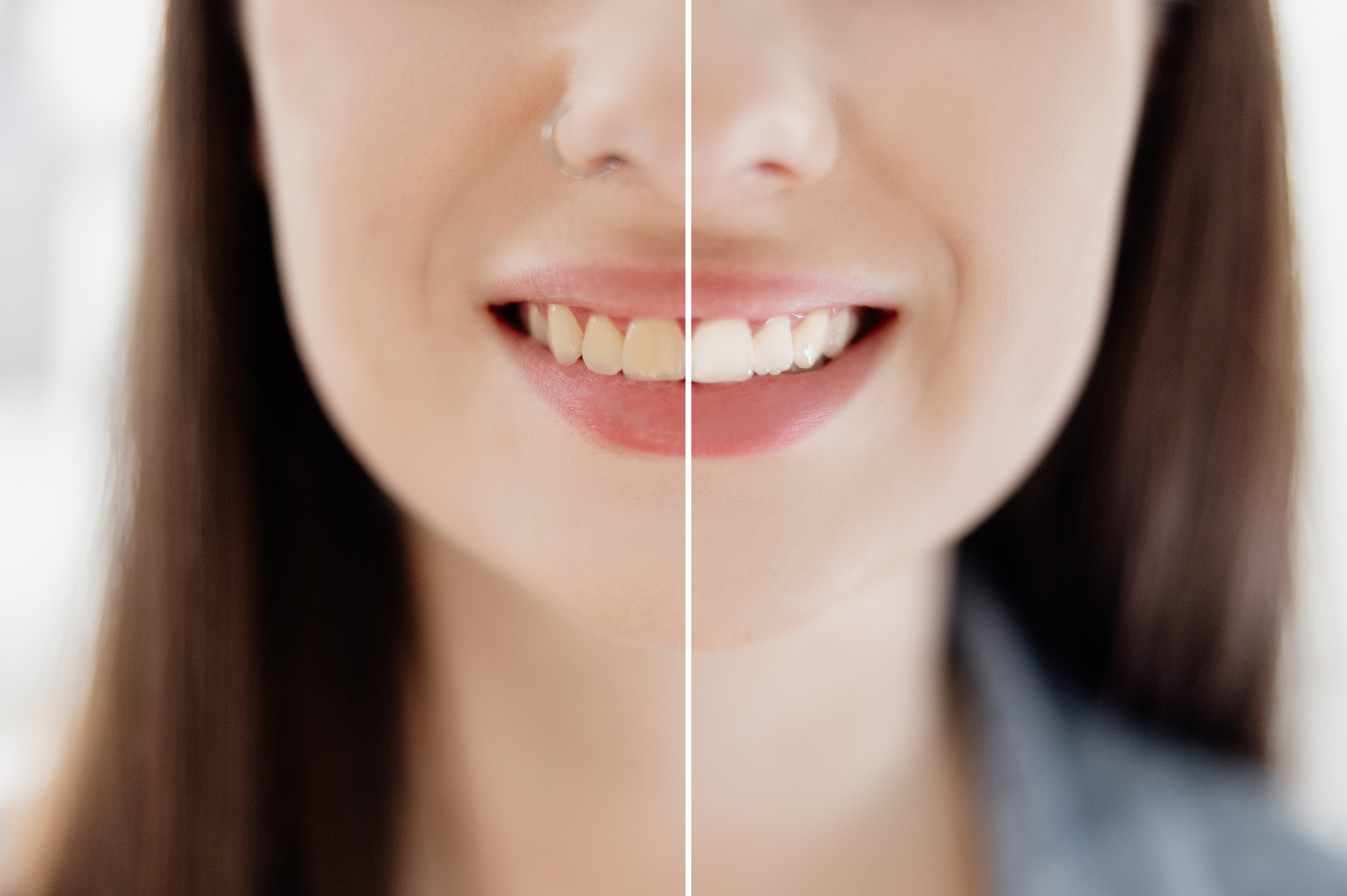 Blanqueamiento dental en Valdebebas