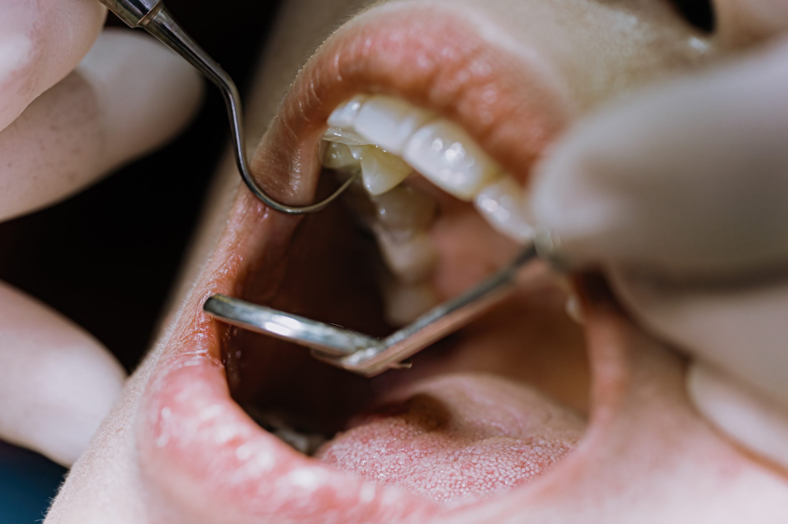 Tratar caries dentales en Valdebebas